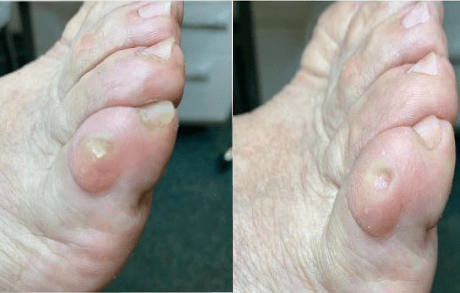 Стержневые мозоли