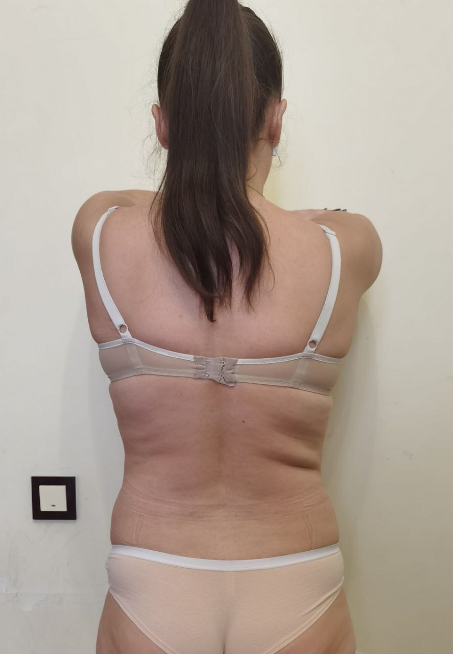 убрать складки на боках