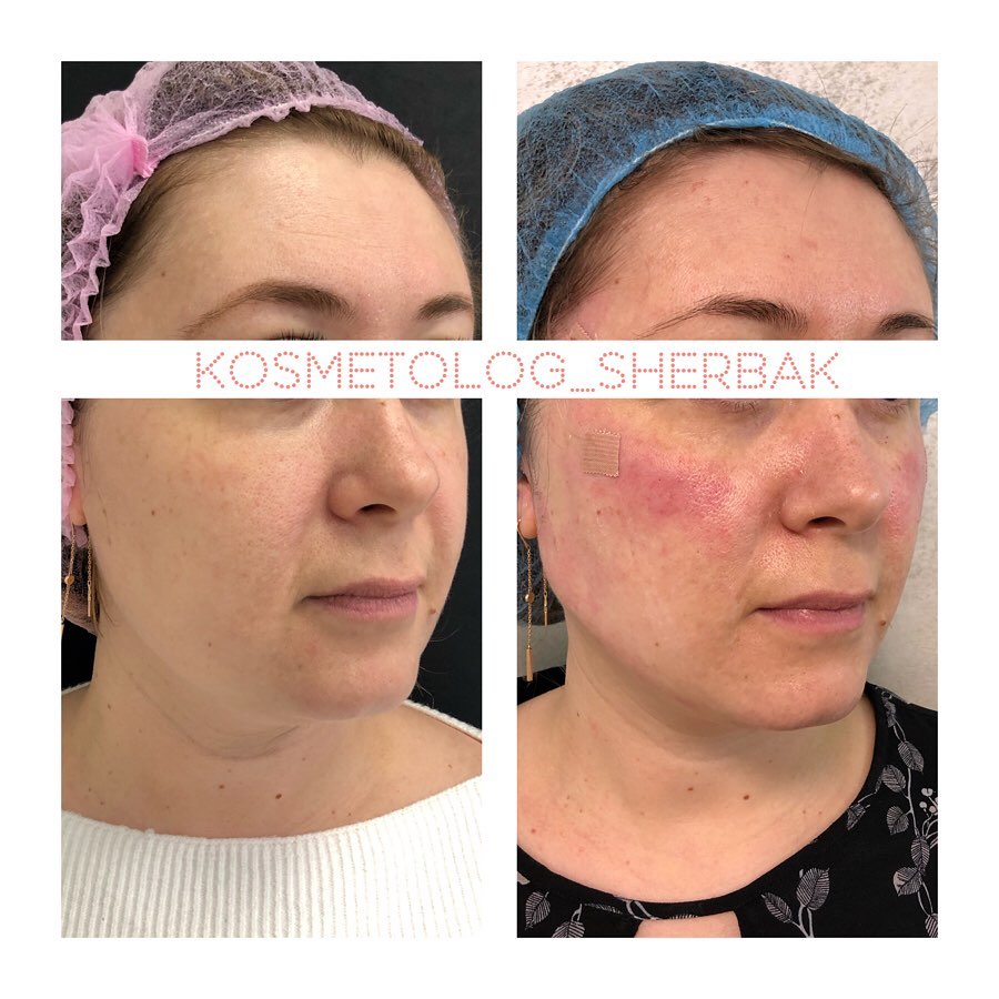 Фото до и после: нитевой лифтинг лица в клинике PradusCOSMO, Санкт-Петербург. Безоперационное омоложение с сохранением естественной мимики