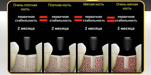 Наращивание кости отзыв