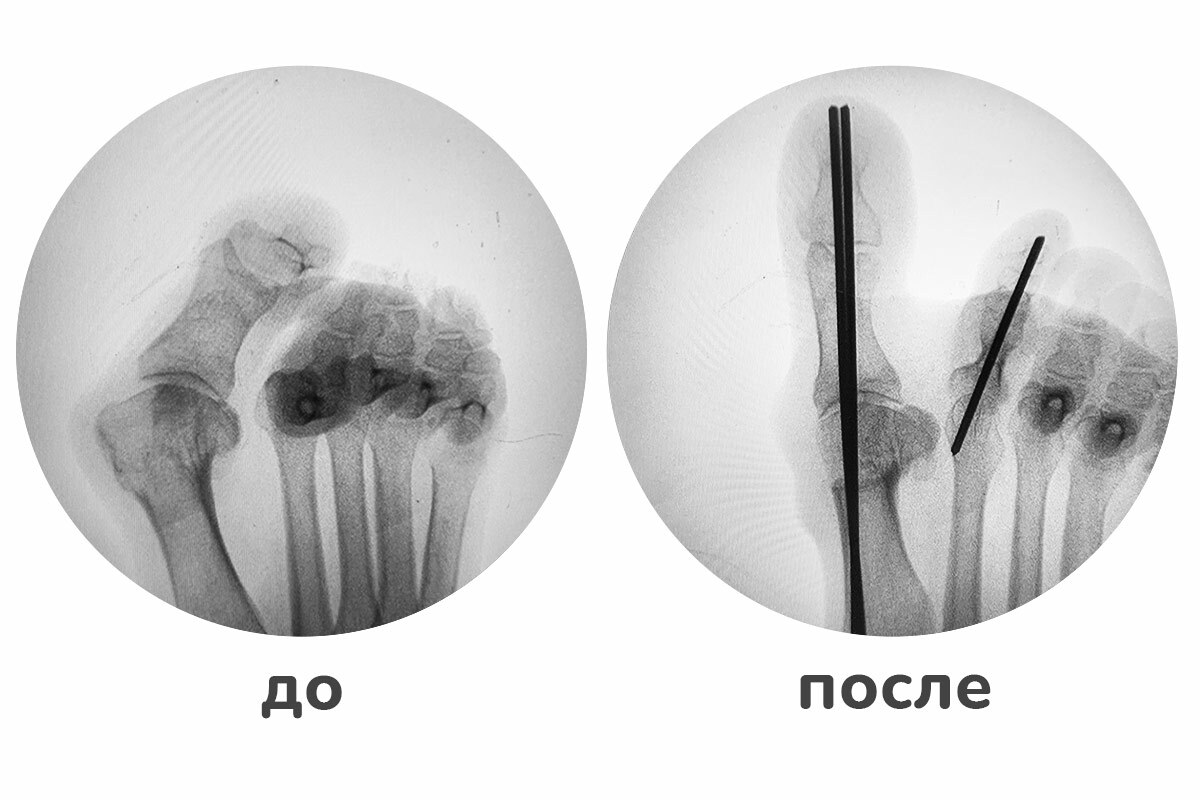 Халюс вальгус спицами