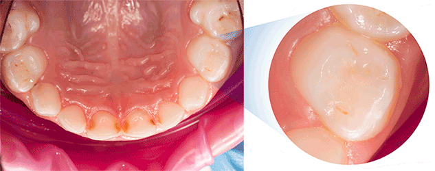 лечение зубов с микроскопом
