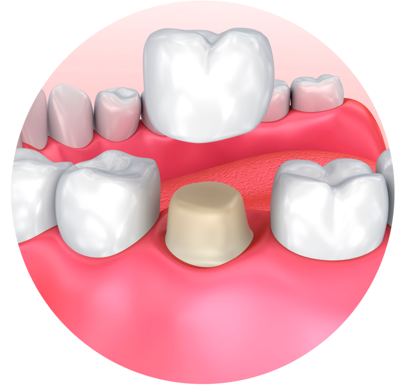 Стоматологические коронки. Искусственные коронки. Зуб с короной. Стоматологические коронки на зубы.
