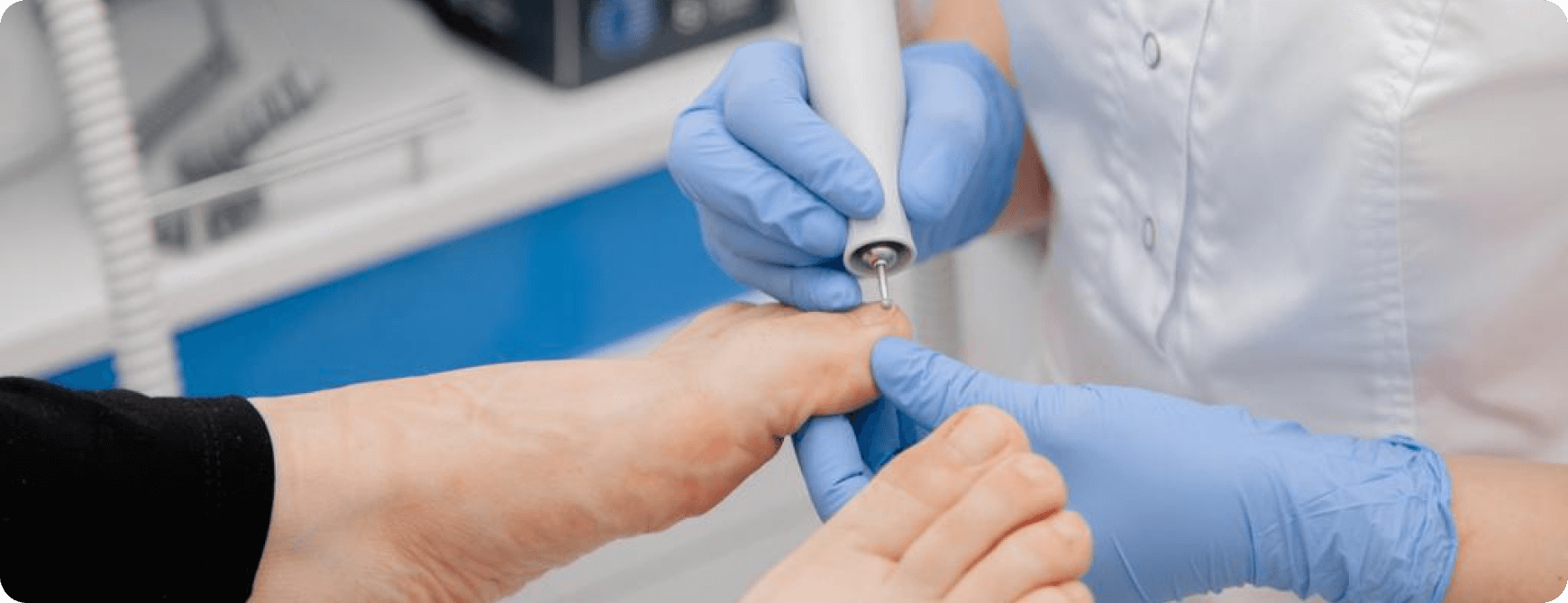 подолог стержневая мозоль, подолог удаление бородавки, ортопед подолог, детский подолог