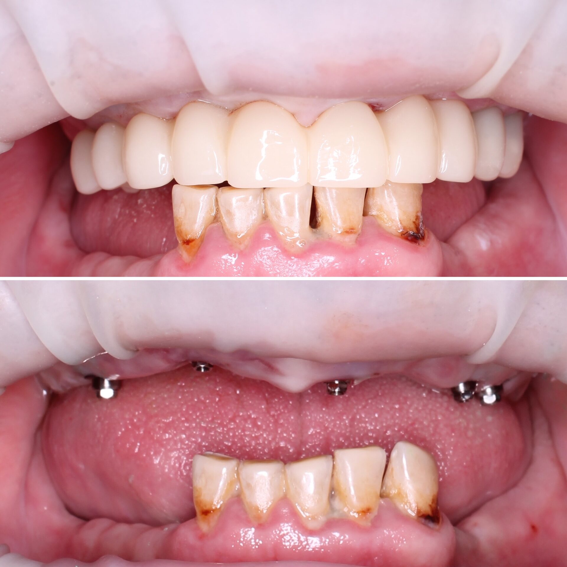 имплантация зубов чебоксары,имплантация зубов йошкар-ола,тотальная реабилитация на 6 имплантатах,протез несъемный в чебоксарах