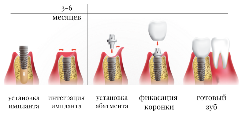 Этапы имплантации зубов. Имплантация зубов этапы установки и сроки. Зубной имплант этапы установки.