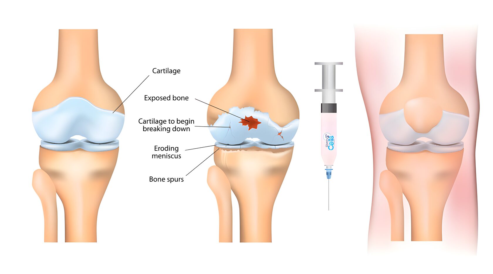 Артроз коленного сустава мениск. Остеоартроз коленного сустава. Остеоартрит коленного сустава. Деформирующий остеоартроз коленного сустава.
