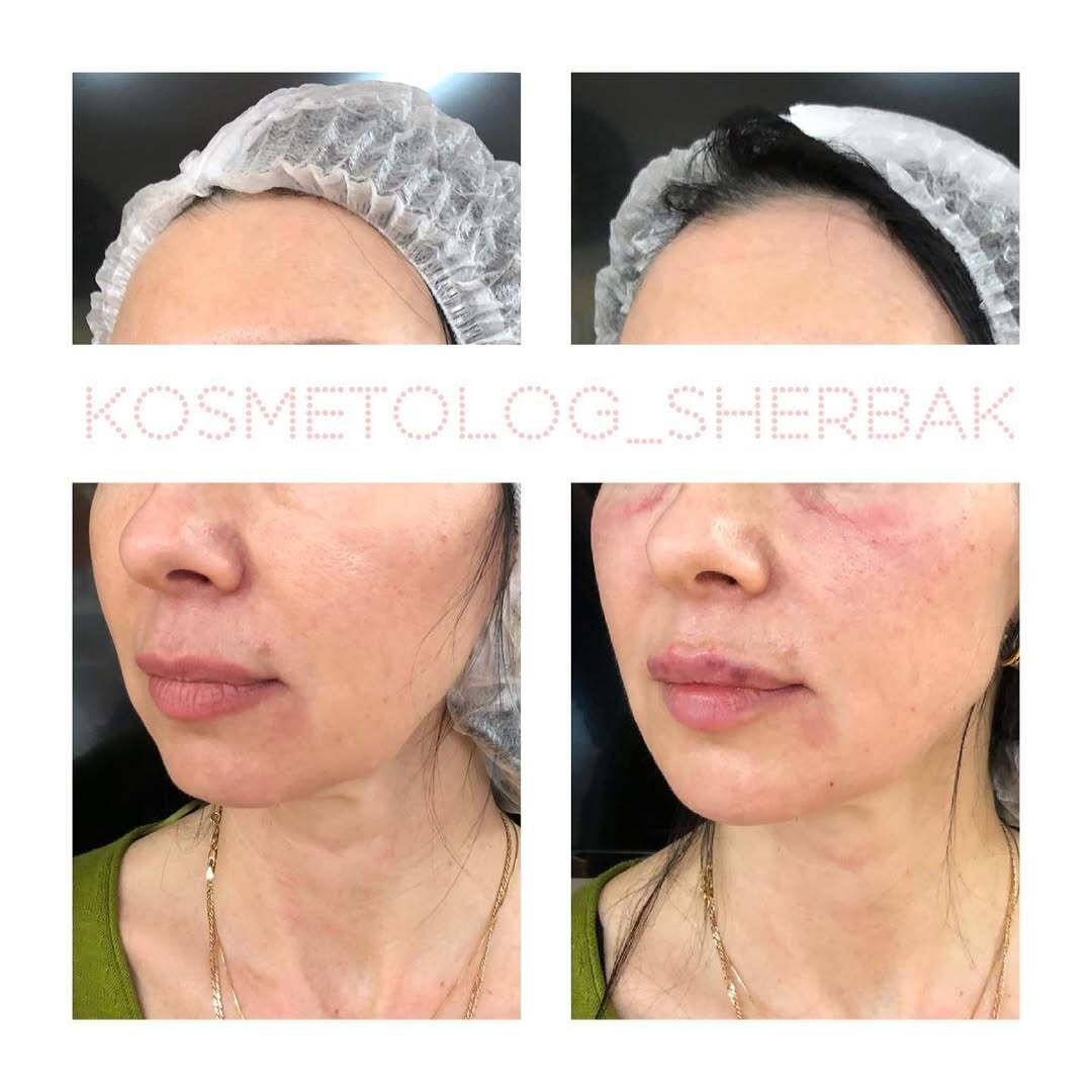 Контурная пластика лица в клинике PradusCOSMO, Санкт-Петербург. Естественный результат без эффекта переделанного лица