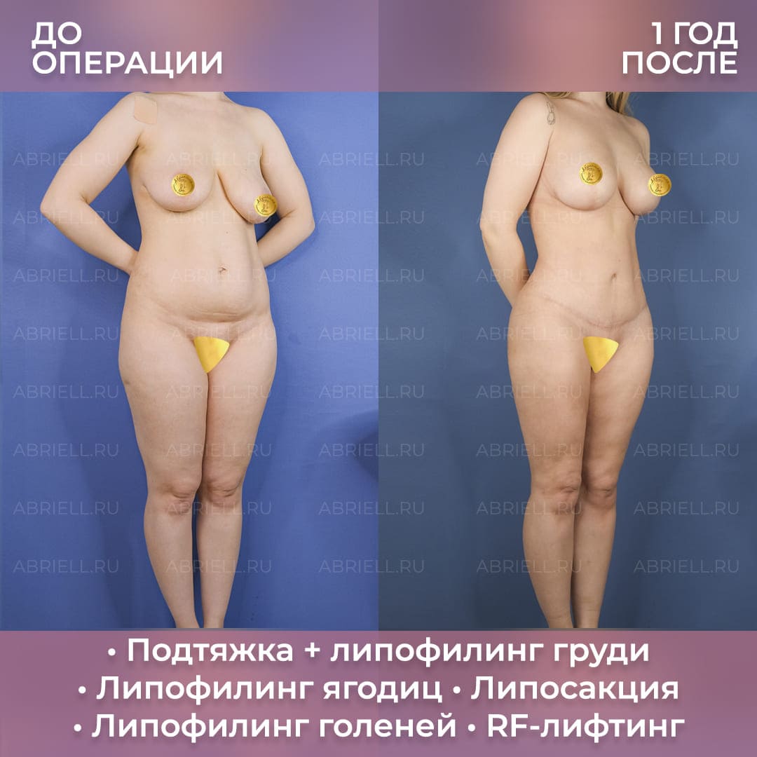 удаление и восстановление груди в одну операцию фото 33