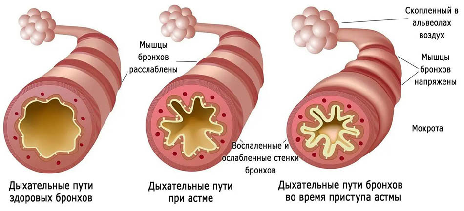 Картинки на тему бронхиальная астма