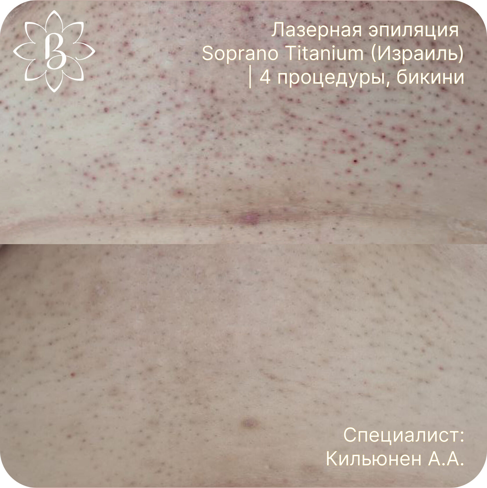 Лазерная эпиляция до после