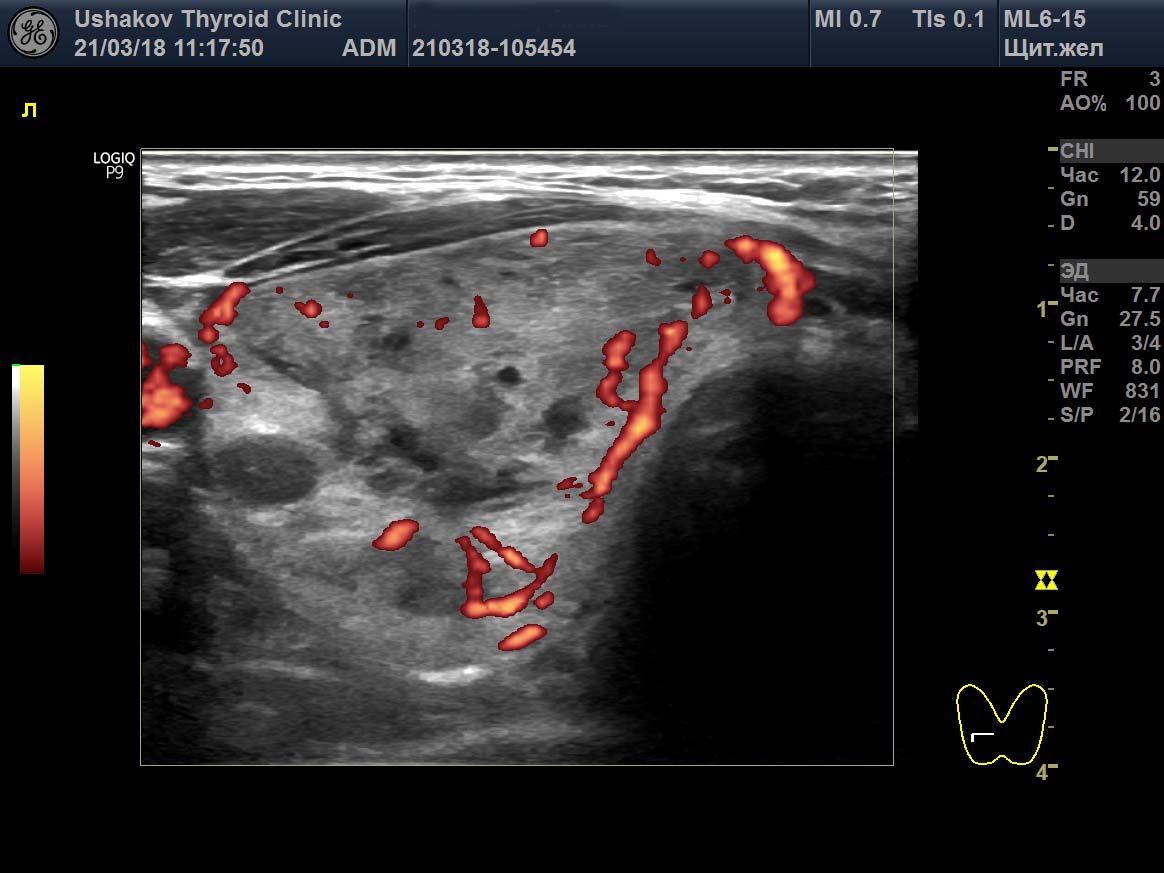 образование с единичными локусами кровотока