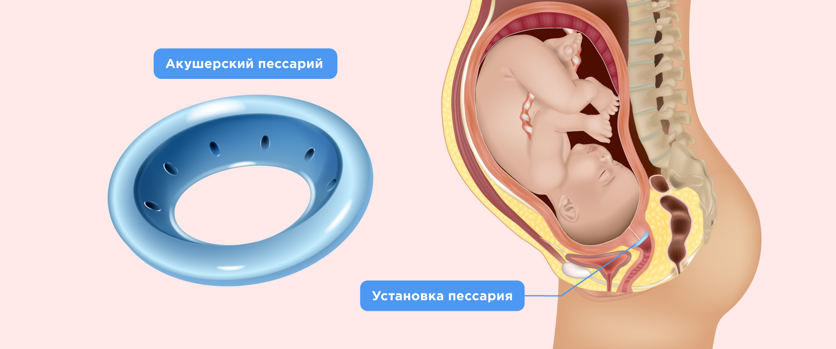 Истмико-цервикальная недостаточность: как вести себя после операции?