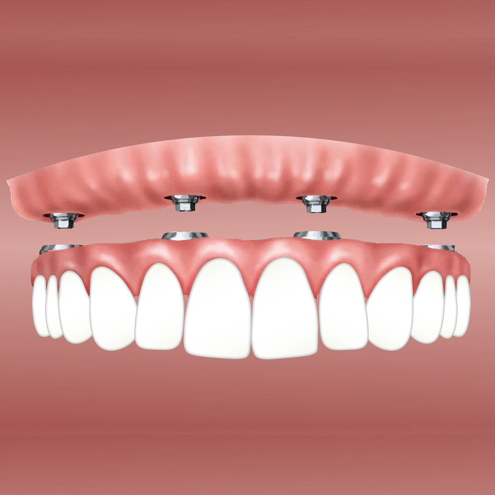 Протезирование зубов виды. Имплантация челюсти на 4 имплантах. Имплантация зубов дентальная на 4 имплантах.