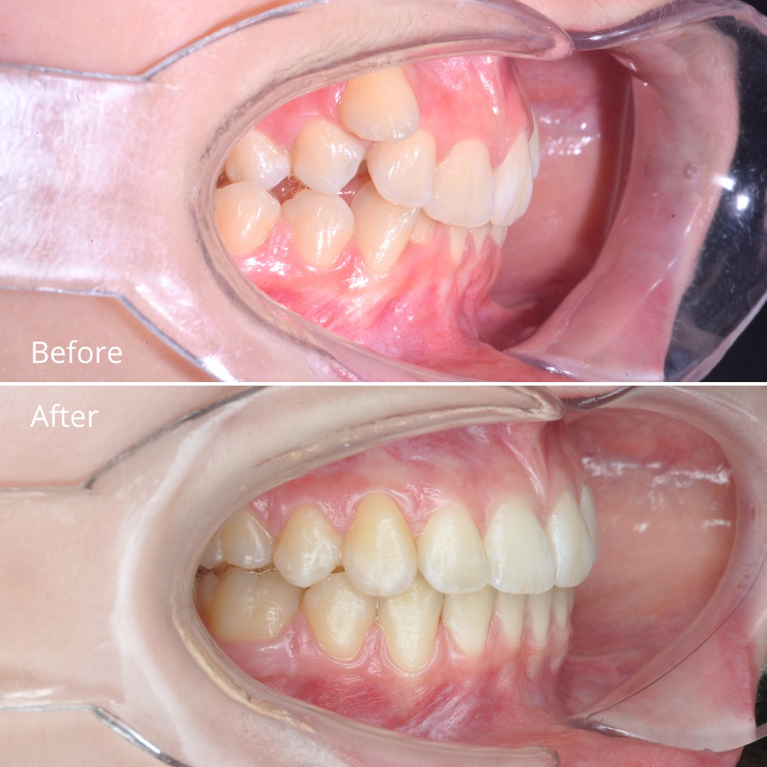 After photo showing a harmonious, stable result after premolar extraction — photo 4 of 4