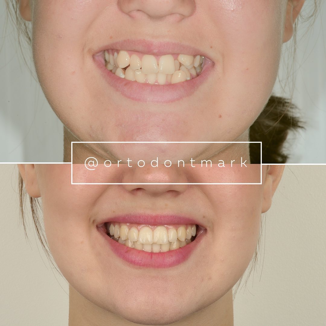 Before and after collage showing the overall result of completed orthodontic treatment