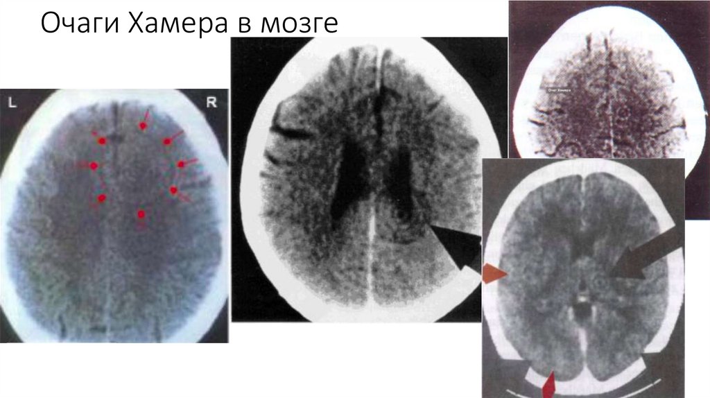 Очаг мозга. Очаги Хамера на кт. Кт головного мозга по Хамеру. Очаги Хаммера. Очаг Хамера в головном мозге.