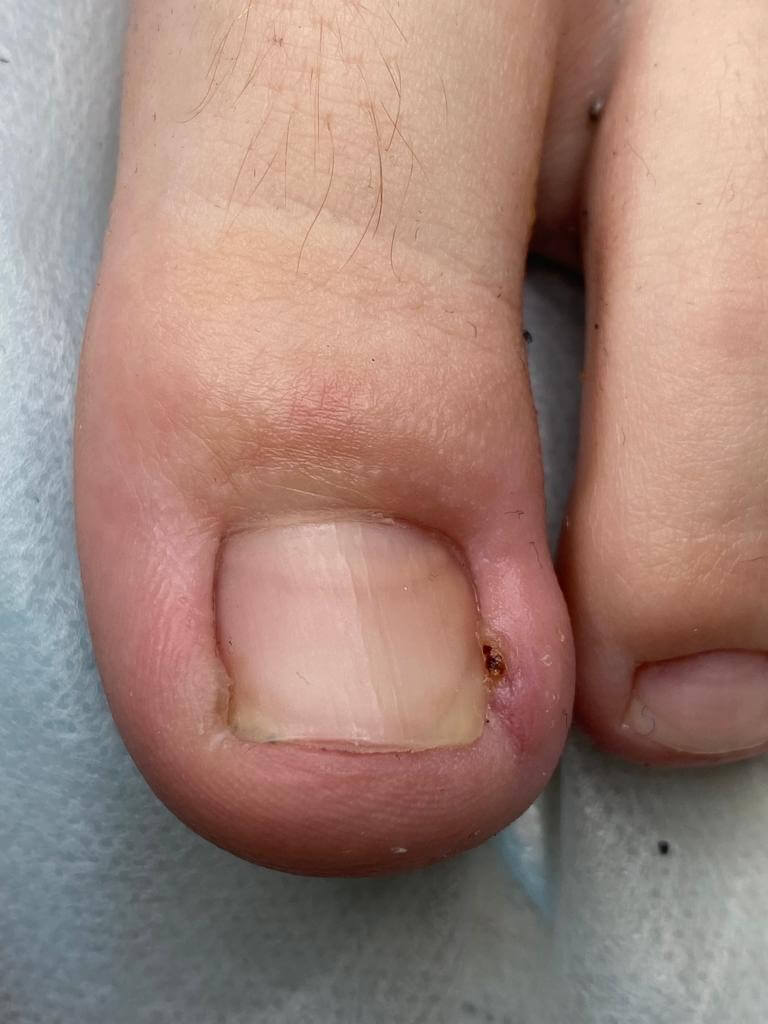 Прогресс вросшего ногтя