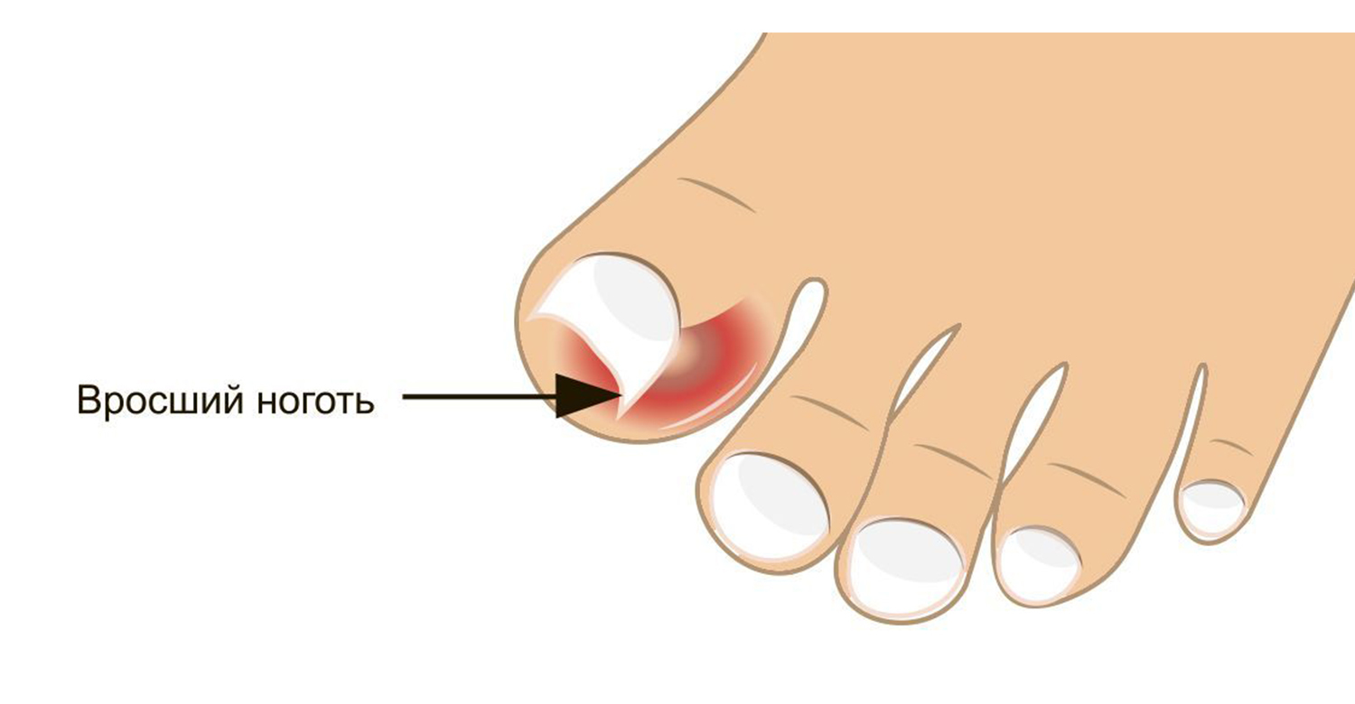 Лечение и удаление вросшего ногтя в Перми