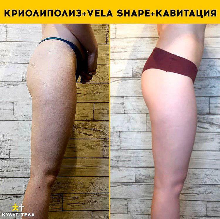 Вела шейп отзывы. Вела Шейп. Vela Shape процедура. Vela Shape массаж.