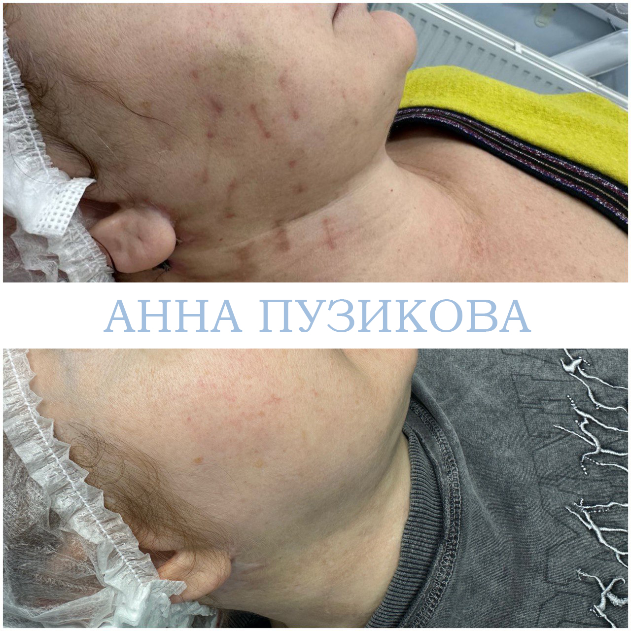 Результат удаления шрама у пациента — косметолог Пузикова Анна Анатольевна, Санкт-Петербург