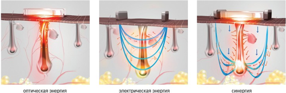 Ipl shr эпиляция и омоложение кожи