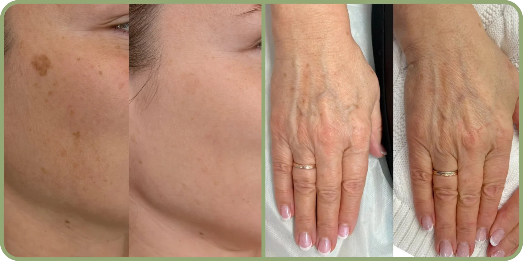 Результат фотоомоложения в клинике Uniqderm