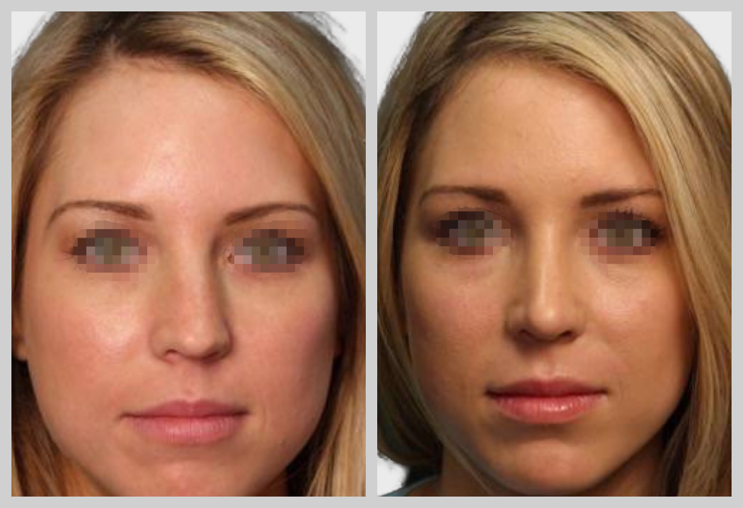 ринопластика пластическая хирургия