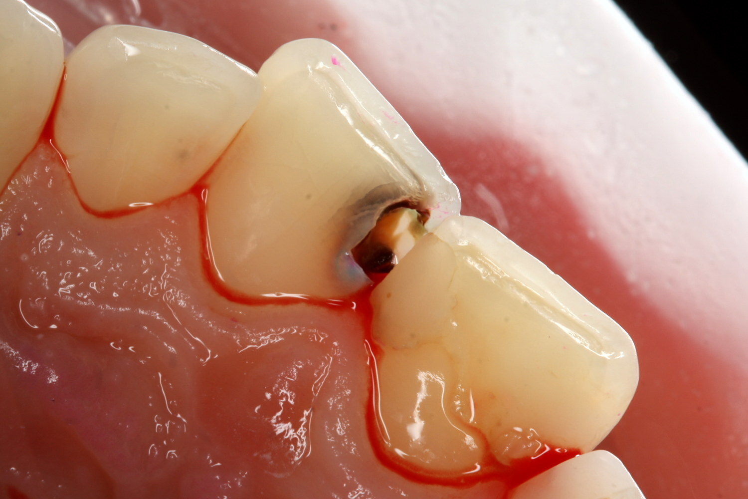 Раскрытие полости контактного кариеса переднего зуба