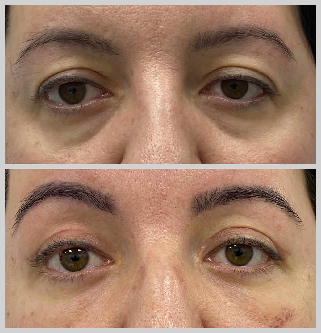 блефаропластика нависшие веки