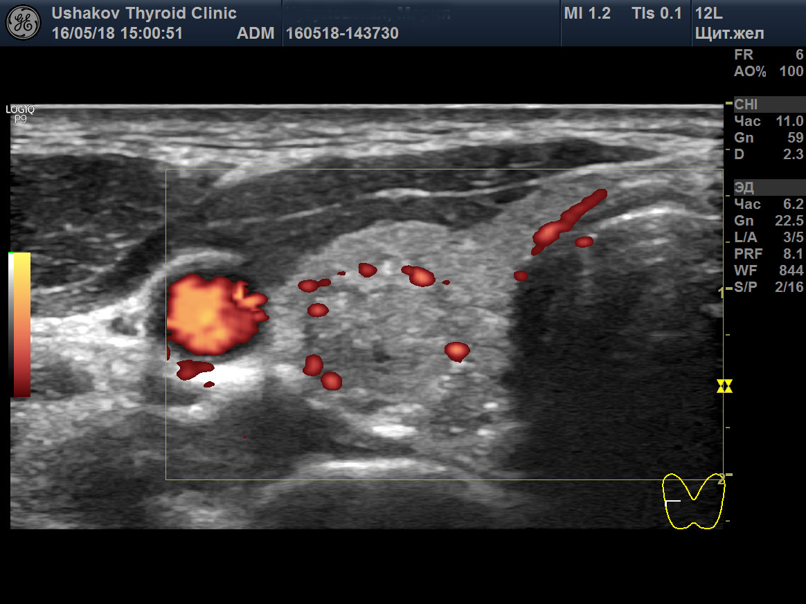 Климакс на узи. Допплерография сосудов щитовидной железы протокол. Дуплексное сканирование сосудов щитовидной железы протокол. Кровоток щитовидной железы УЗИ. УЗИ щитовидной железы с допплерографией сосудов.