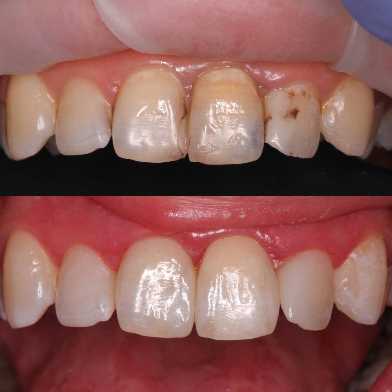 Реставрация фронтальных зубов 4k