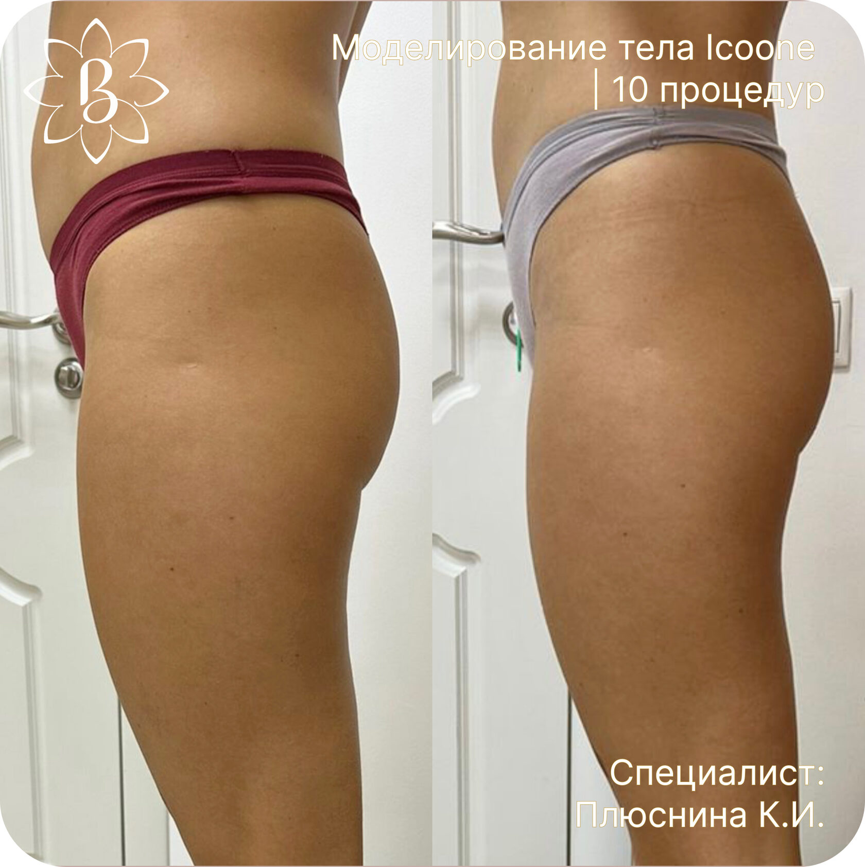 Диодная лазерная эпиляция СПб