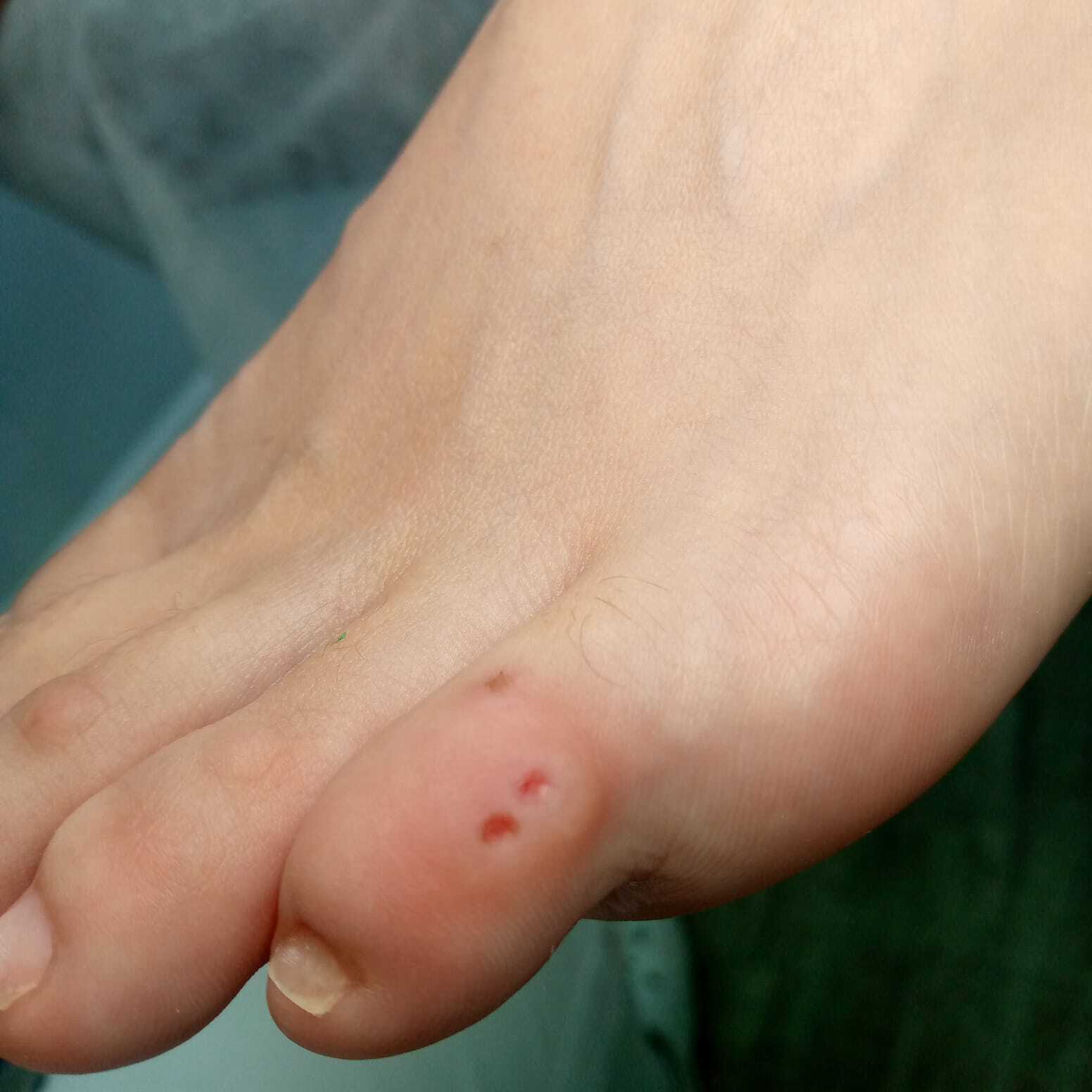 вросший ноготь на ноге, вросший ноготь, удаление вросшего ногтя, вросший ноготь лечение, вросший ноготь операция, удалить вросший ноготь, вросший ноготь цена