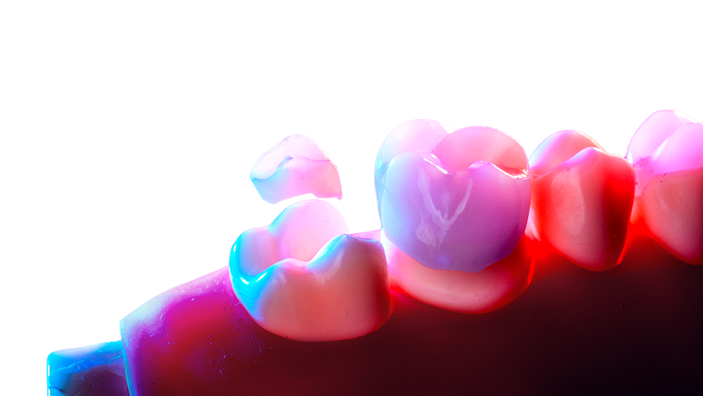 Bonding Zirconia crowns and Ceramic overlays. Stepbystep guide