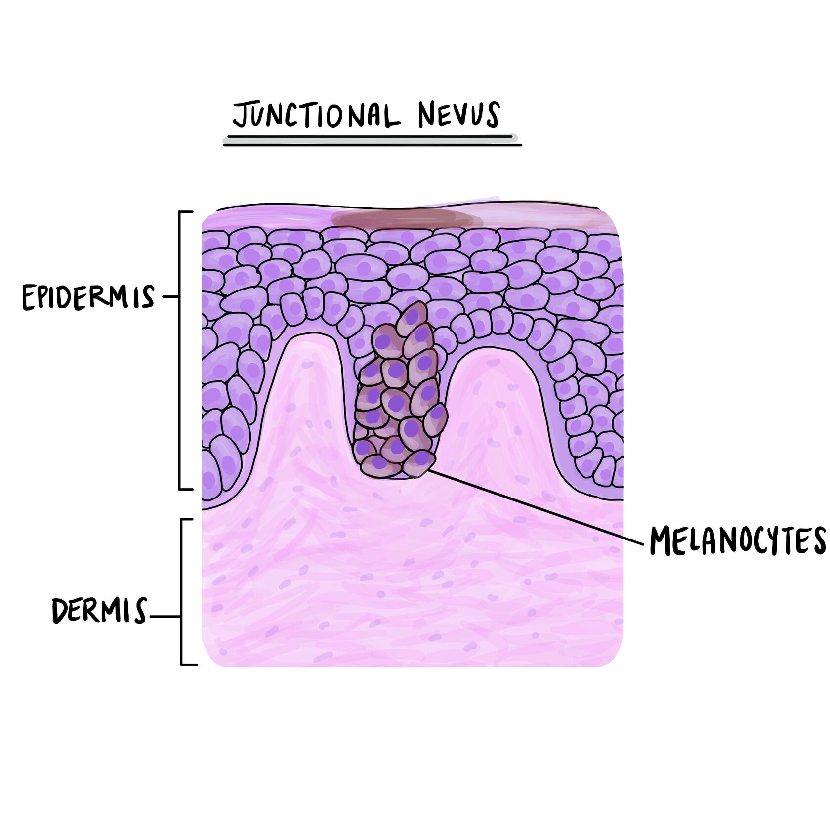 Is a junctional nevus cancerous?