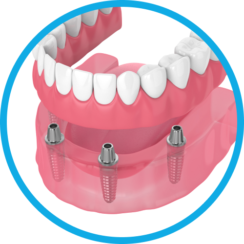 Установка имплантов в Дербенте. Имплантация при отсутствии одного зуба.