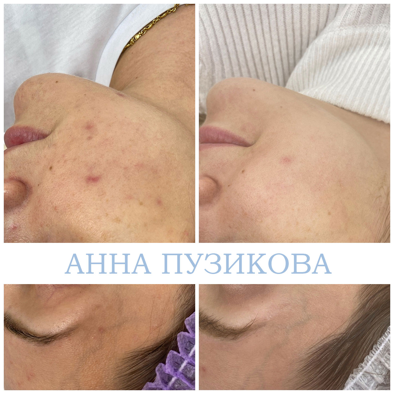 Результат лечения акне и воспалений кожи после курса процедур у косметолога Анны Пузиковой в клинике Прадус (СПб).