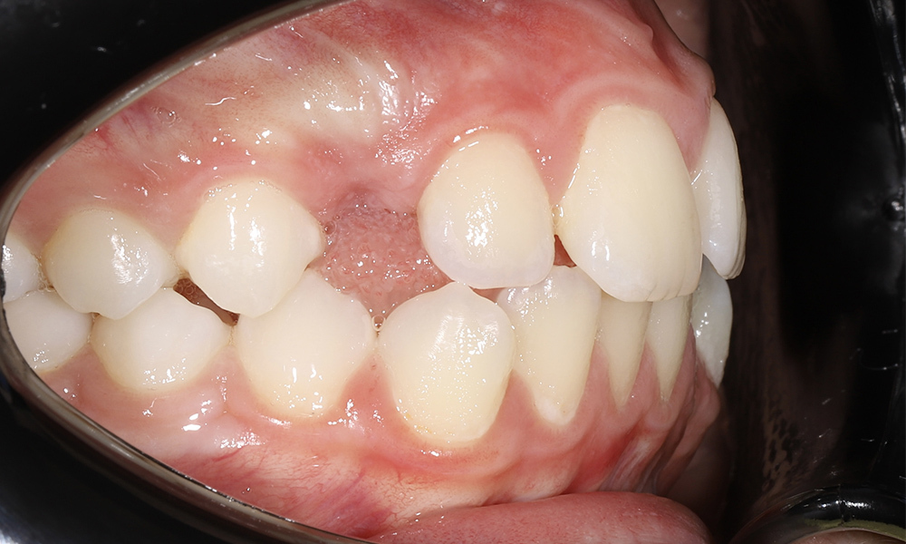 Скелетное расширение верхней челюсти у подростка с жалобами на нарушение носового дыхания