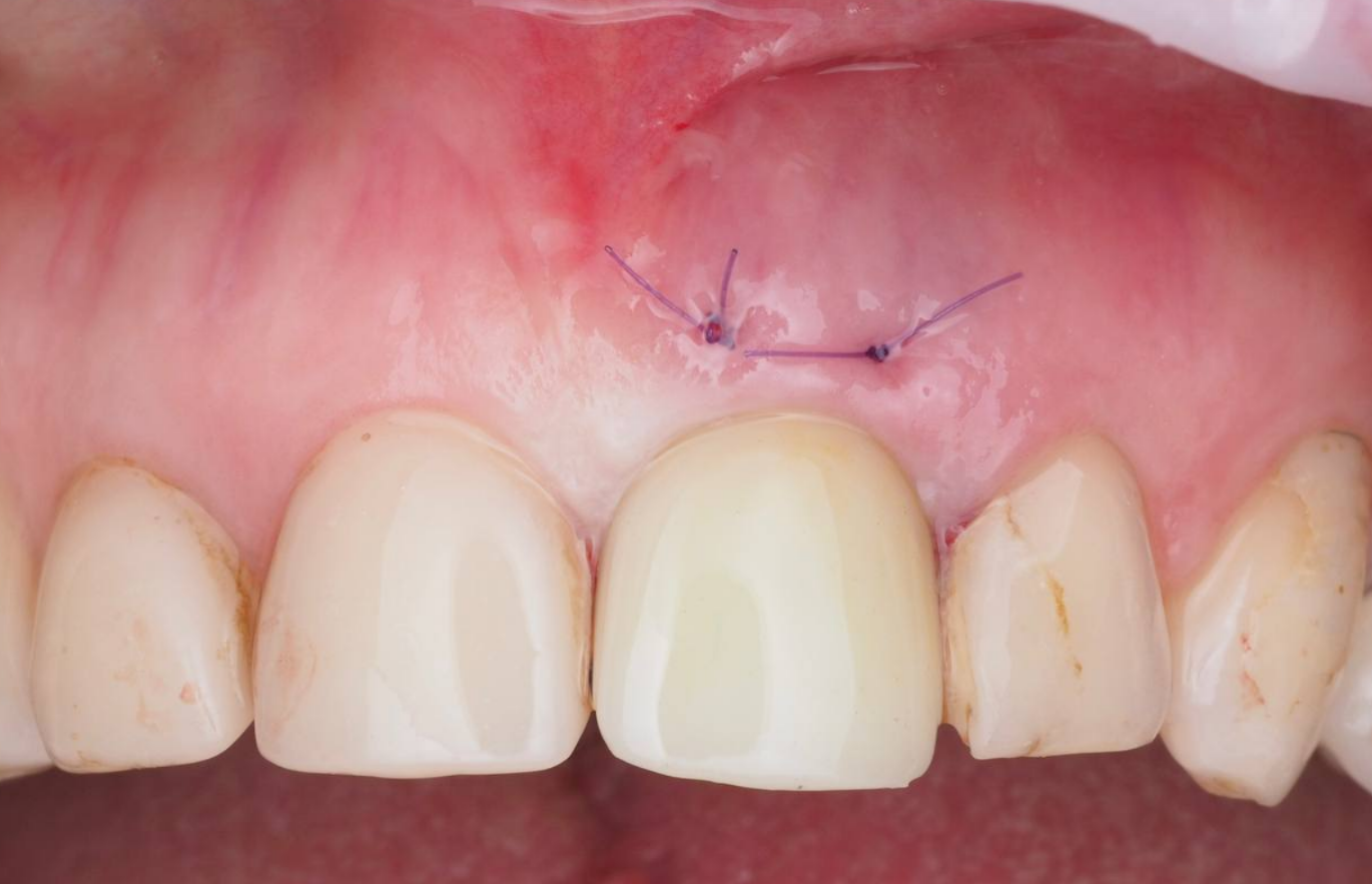временная коронка на импланте
