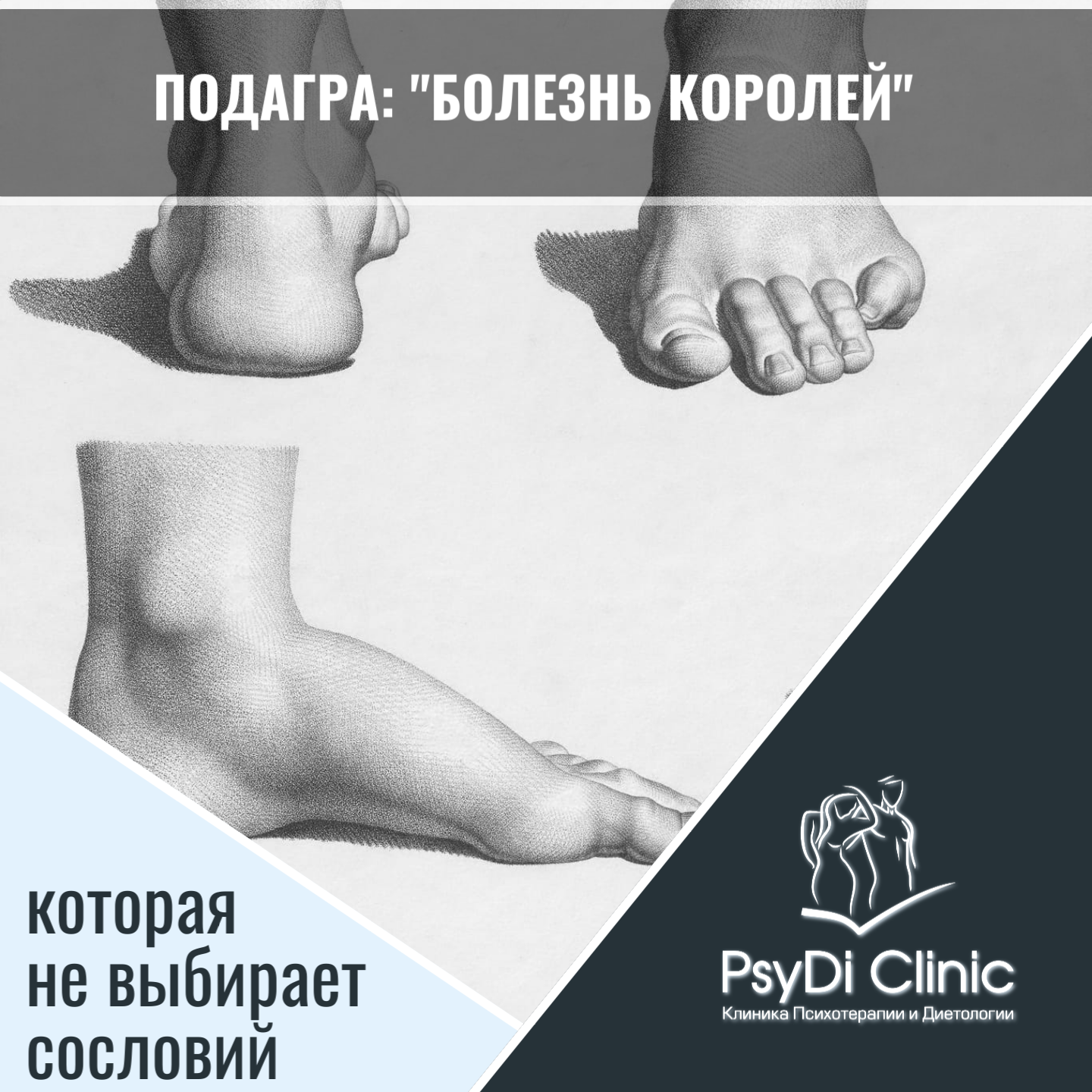 Подагра: &amp;amp;quot;болезнь королей&amp;amp;quot;, которая не выбирает сословий