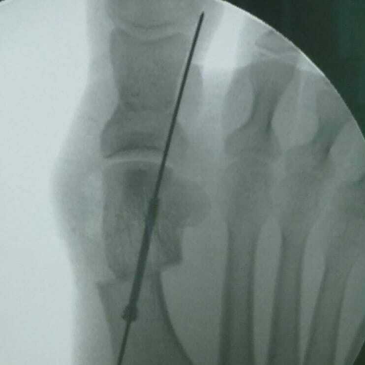 Фиксация винтами при операциях на стопах — хорошо или плохо?