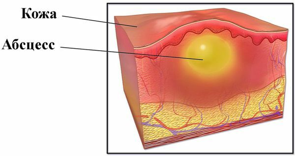 Фолликулит и абсцессы кожи