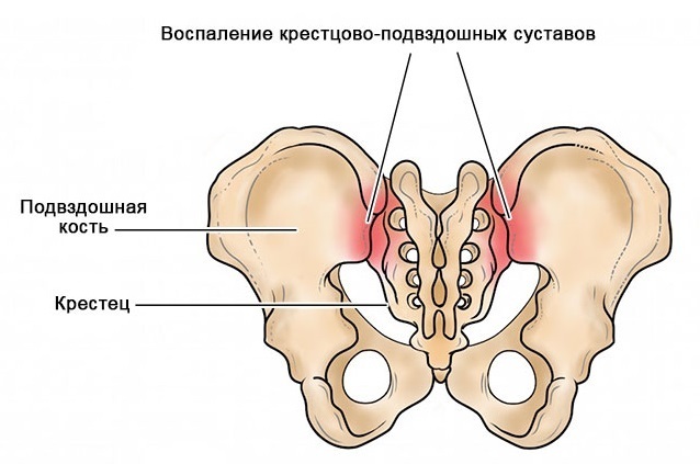 Подвздошно-крестцовый синдром