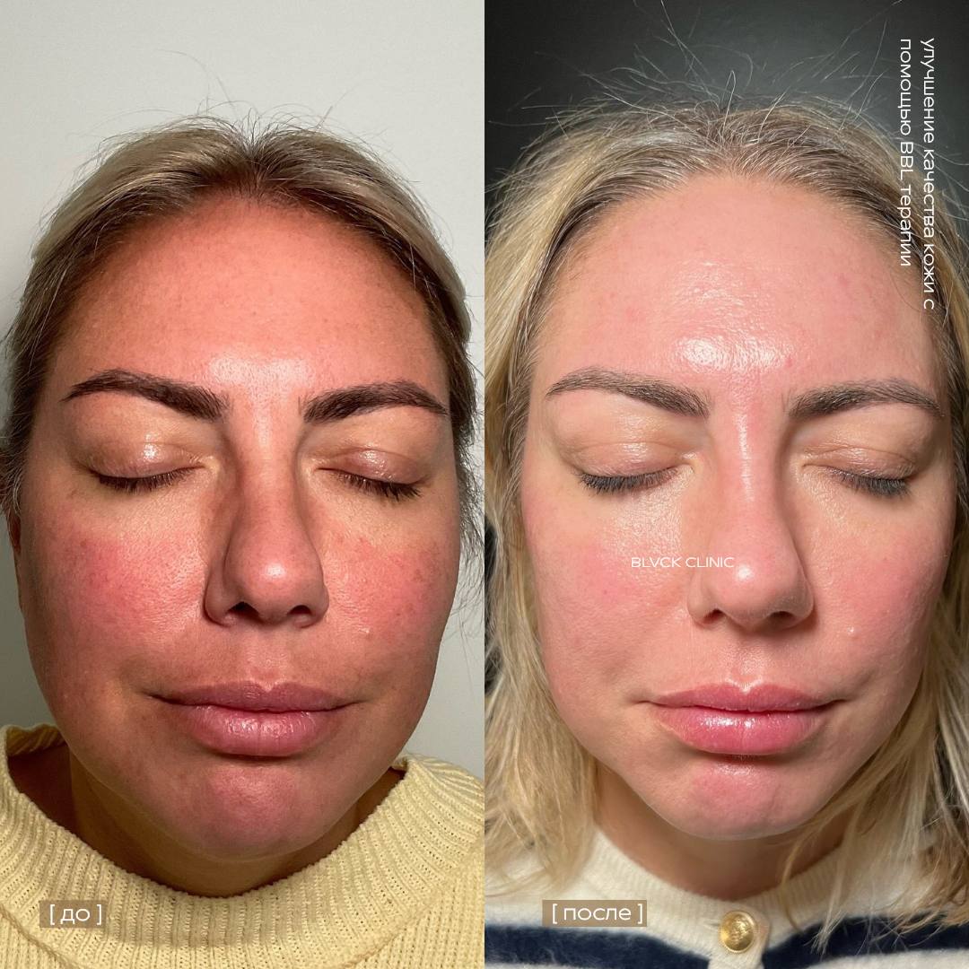 До и после удаления пигментных пятен в Blvck Clinic