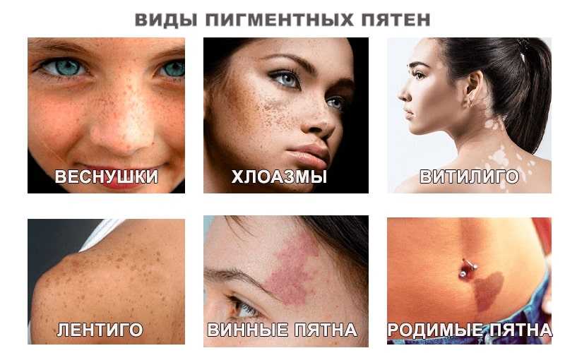 Пигментация кожи, как избавиться от пигментных пятен на теле в летний период