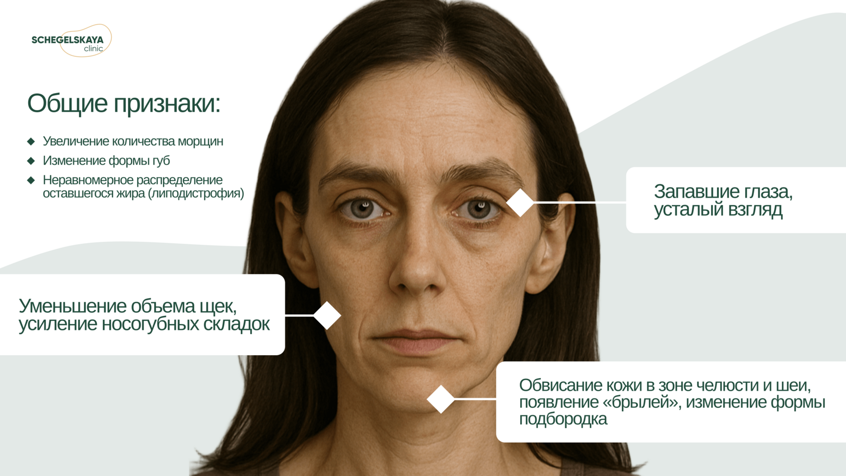Инфографика: основные признаки Ozempic Face — запавшие глаза, усталый взгляд, уменьшение объема щек, обвисание кожи, появление брылей.