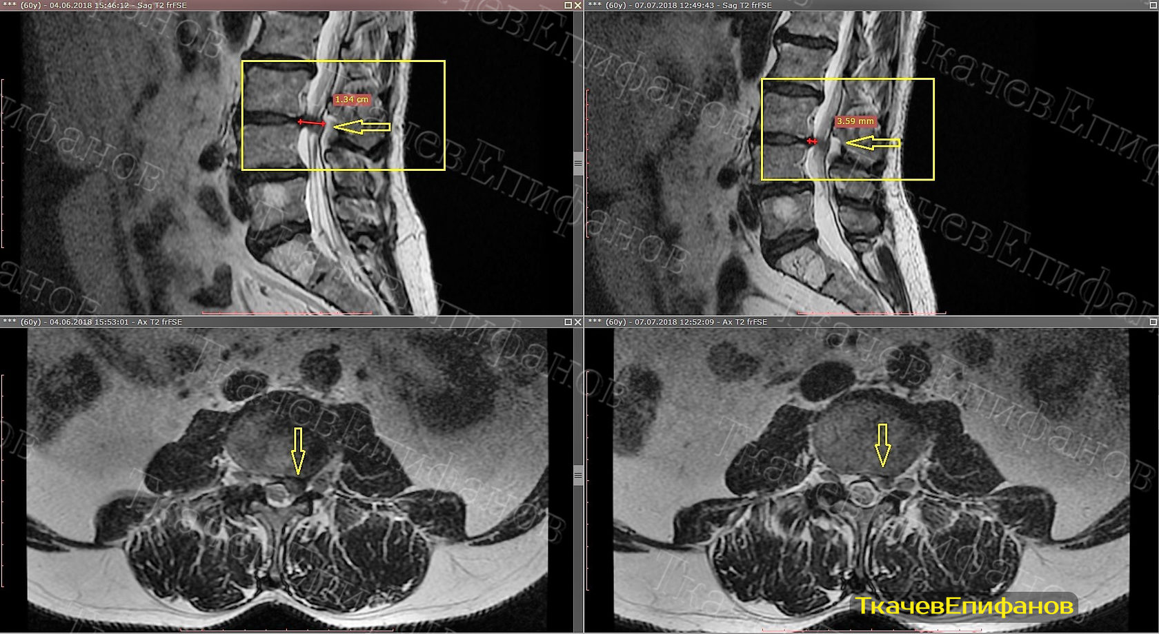 Вытяжение позвоночника детензор отзывы. Епифанов грыжа позвоночника. Епифанов грыжа позвоночника. Епифанов грыжа позвоночника. Грыжа 56 лет норма антон епифанов.