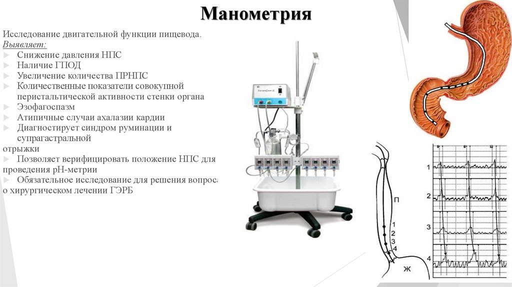 Манометрия сфинктера. Поэтажная манометрия верхних отделов ЖКТ. Манометрия высокого разрешения пищевода. Манометрия сфинктера Одди как делается. Ахалазия кардии манометрия.