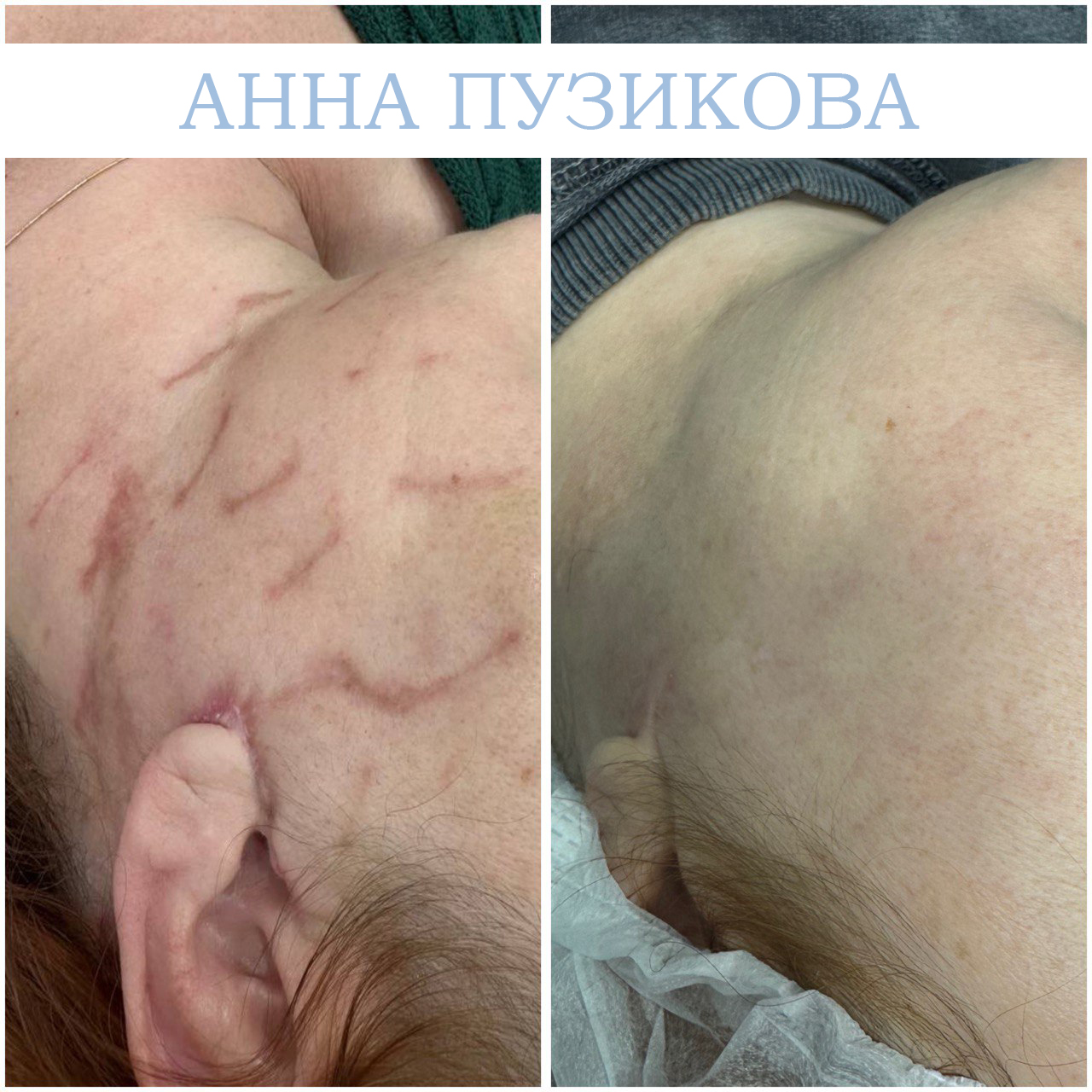 Результат удаления шрама у пациента — косметолог Пузикова Анна Анатольевна, Санкт-Петербург